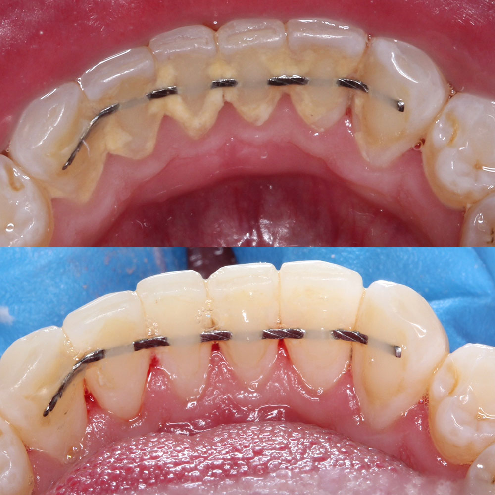 Before-and-after dental photo, case 1