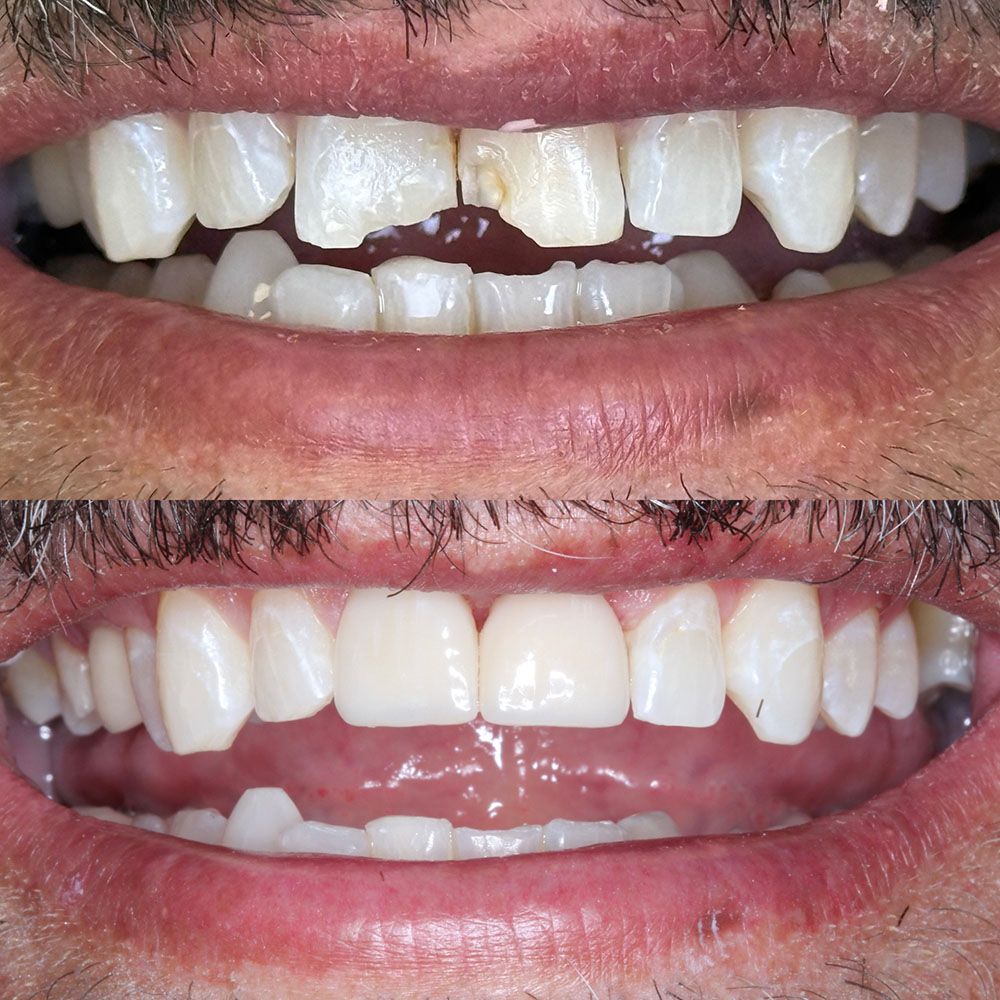 Before-and-after dental photo, case 2