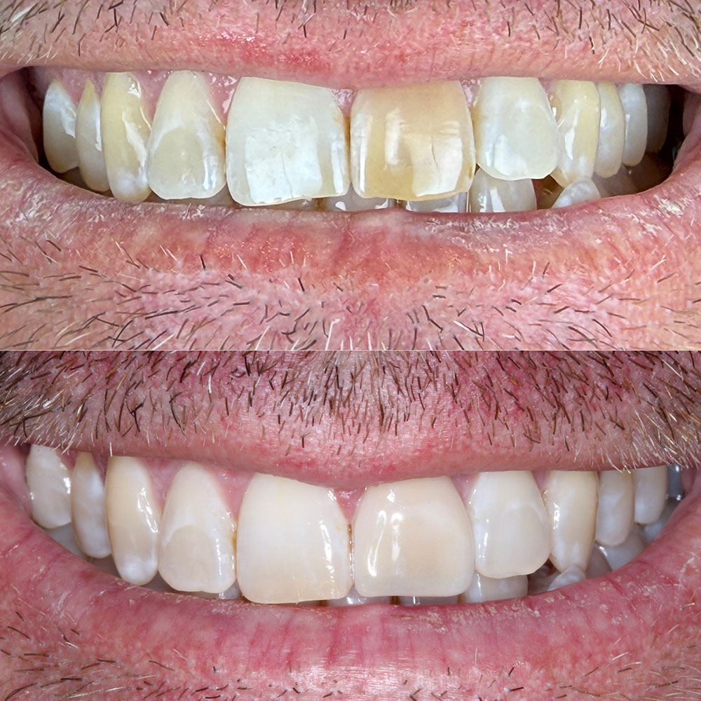 Before-and-after dental photo, case 3