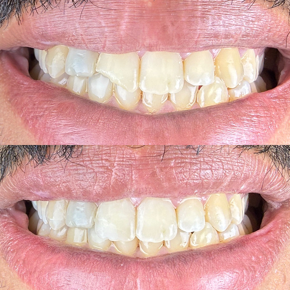 Before-and-after dental photo, case 4