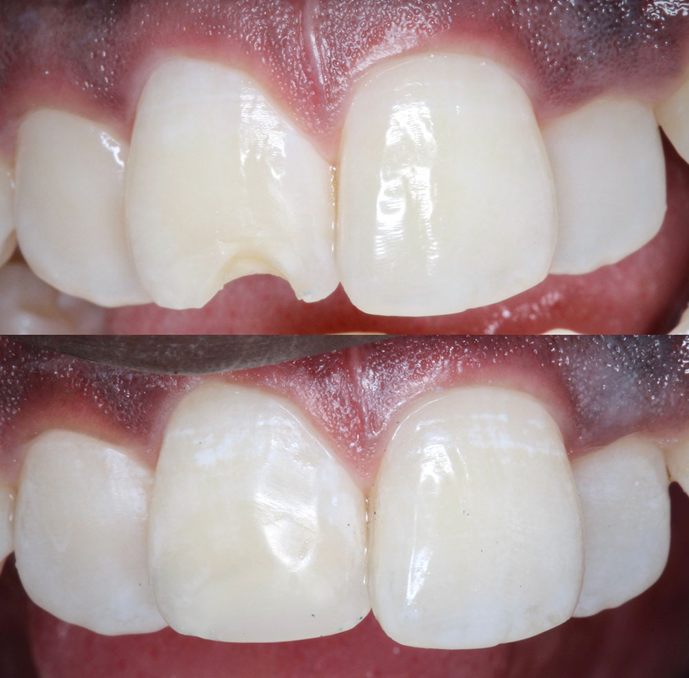 Before-and-after dental photo, case 5
